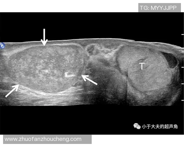 足球明星罹患睾丸肿瘤的真实故事与勇敢抗争经历